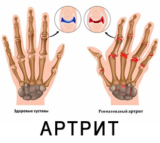 Артрит