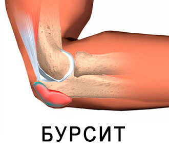 Бурсит