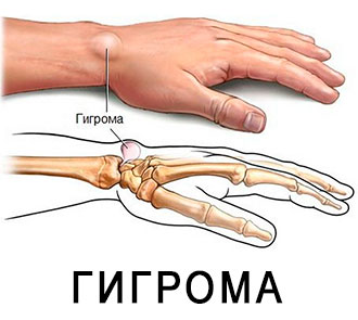 Гігрома