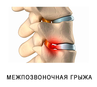 Міжхребцева грижа