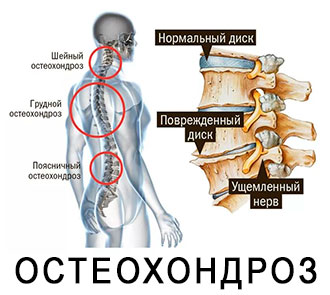 Остеохондроз