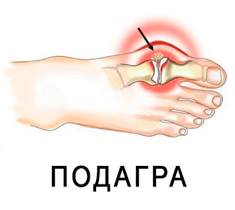 Подагра