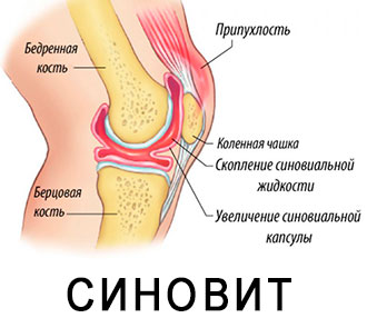 Синовіт
